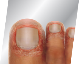 What is Toe Fungus